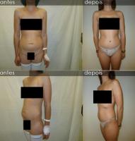 Abdominoplastia 1